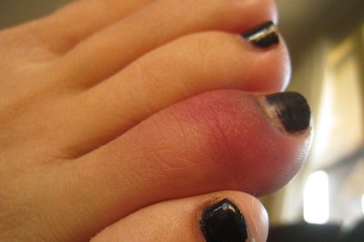 How to Mend a Broken Toe at Home 4