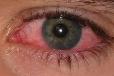 Natural Treatment of Conjunctivitis (Pink Eye)