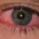 Natural Treatment of Conjunctivitis (Pink Eye)